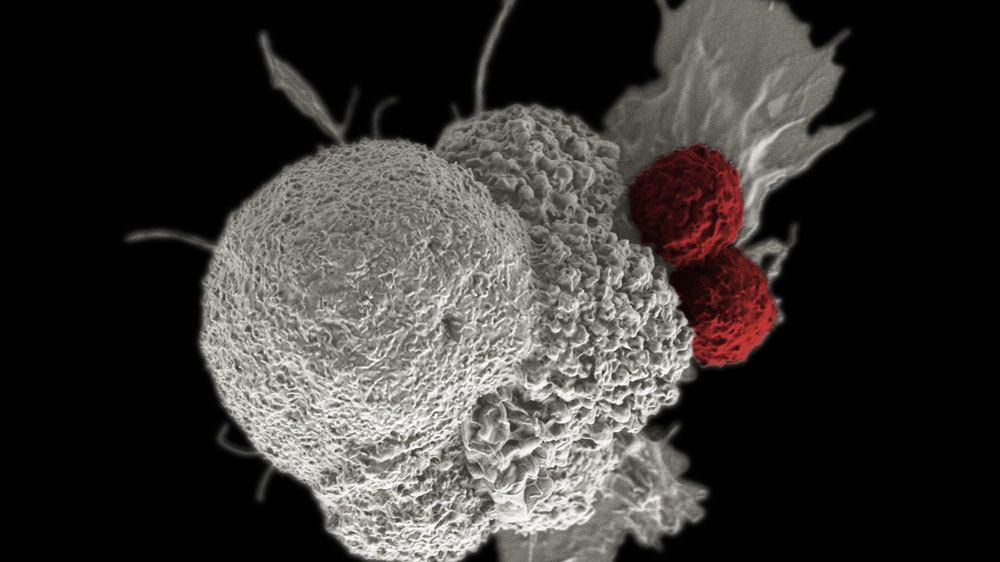 : scanning electron micrograph of a cancer cell being attacked by two T cells.